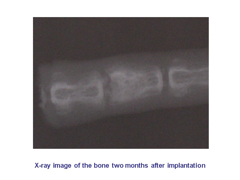 X-ray image of the bone two months after implantation